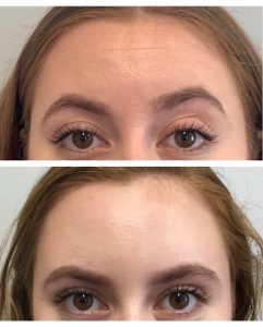 Before and After Dysport