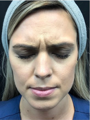 Botox Before